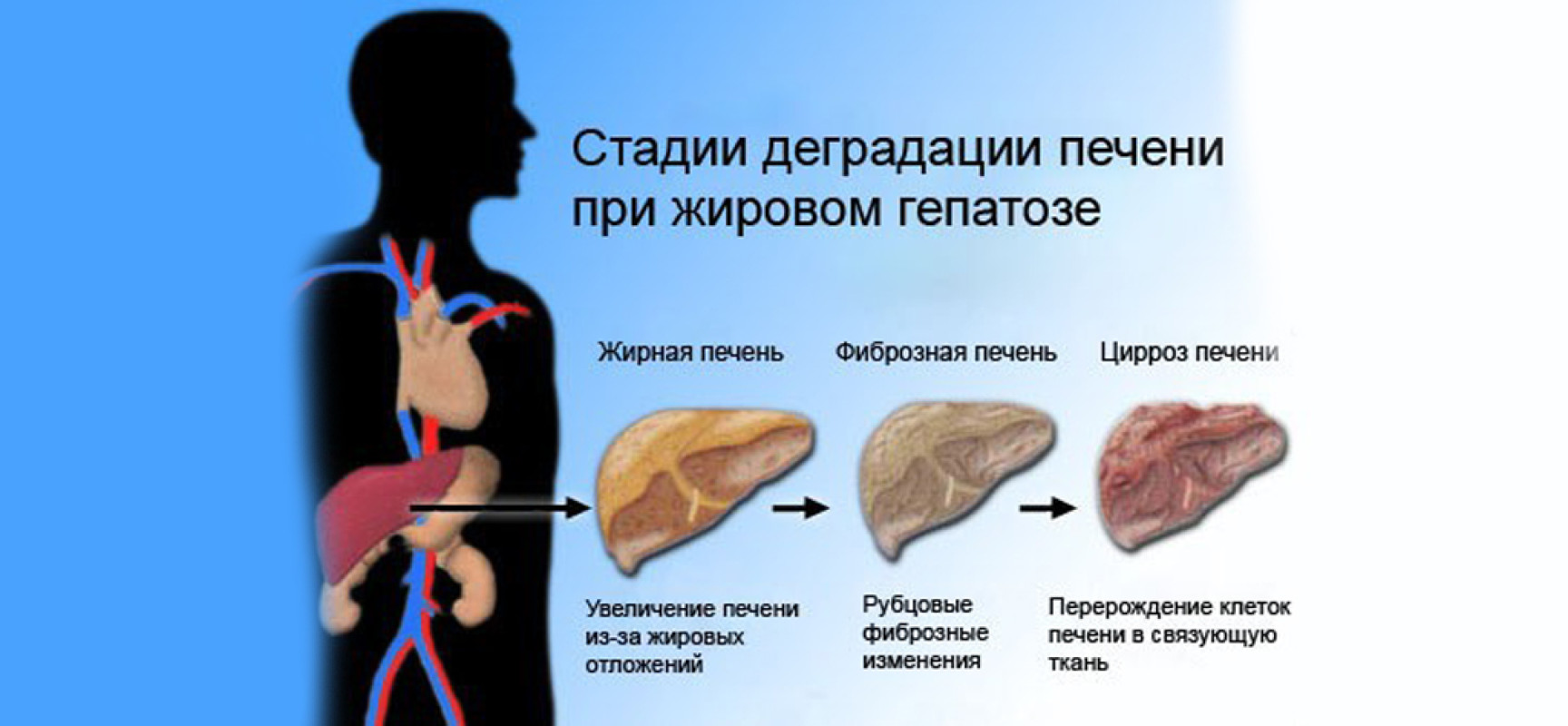 Жирового гепатоза печени